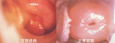 宮頸息肉有哪些癥狀表現